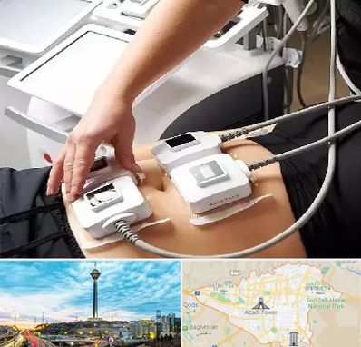 ترواسکالپ در تهران