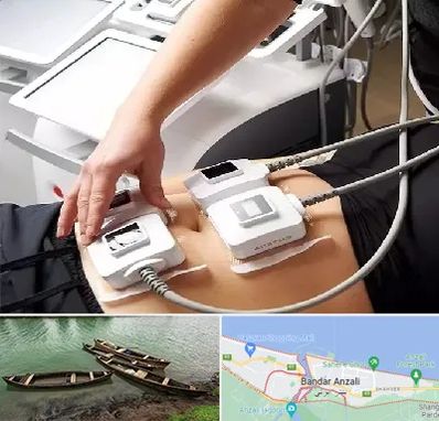 ترواسکالپ در بندر انزلی