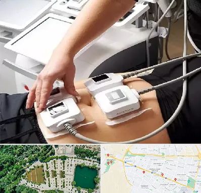 ترواسکالپ در وکیل آباد مشهد 