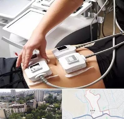 ترواسکالپ در اوین