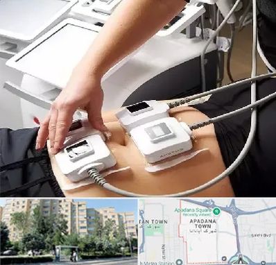 ترواسکالپ در آپادانا