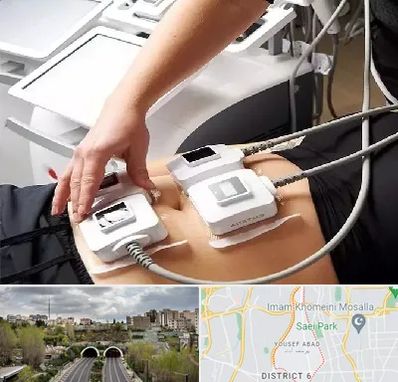 ترواسکالپ در یوسف آباد 