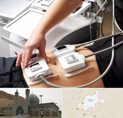 ترواسکالپ در شهرضا