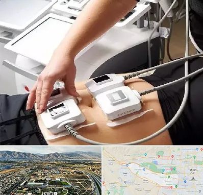 ترواسکالپ در منطقه 21 تهران 