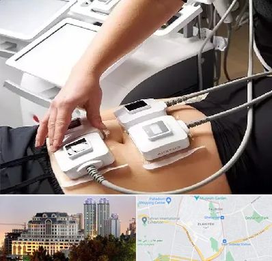 ترواسکالپ در فرشته 