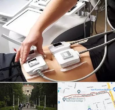 ترواسکالپ در بلوار معلم رشت 