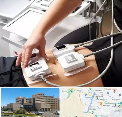 ترواسکالپ در صیاد شیرازی مشهد