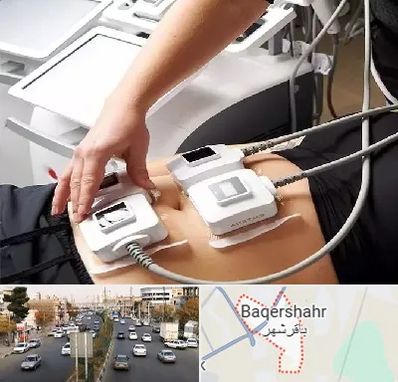 ترواسکالپ در باقرشهر