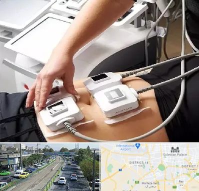 ترواسکالپ در جنوب تهران 