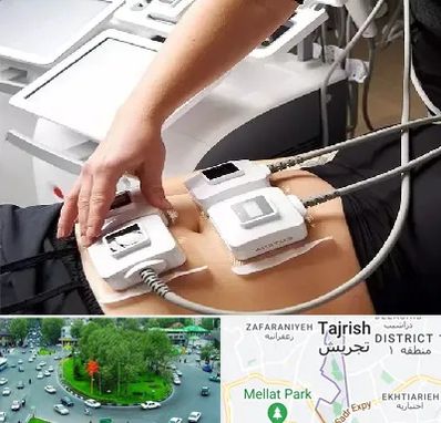 ترواسکالپ در تجریش 