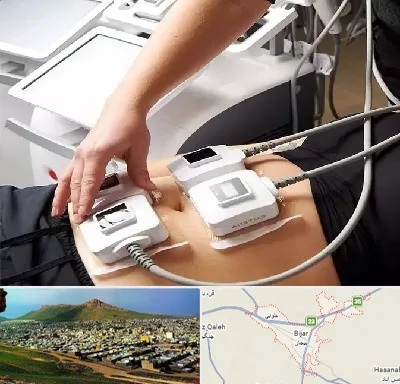 ترواسکالپ در بیجار