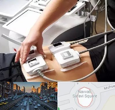 ترواسکالپ در نواب