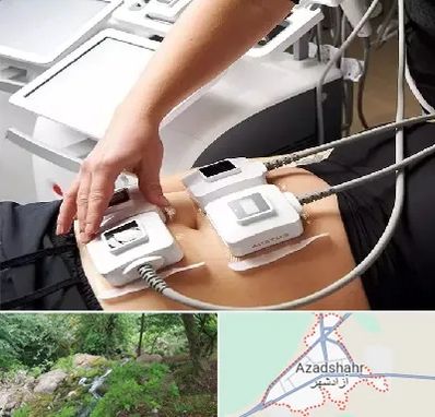 ترواسکالپ در آزادشهر