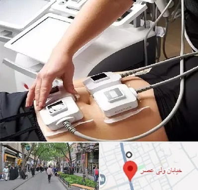 ترواسکالپ در ولیعصر شهریار