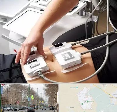 ترواسکالپ در نظرآباد کرج 