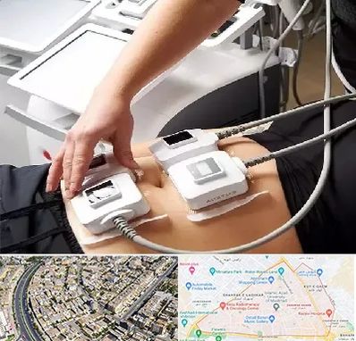 ترواسکالپ در شهرک غرب مشهد