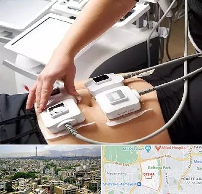 ترواسکالپ در گیشا 