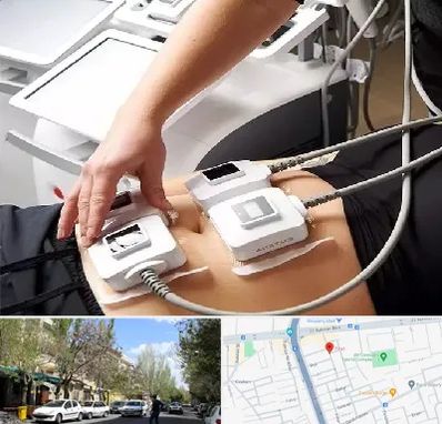 ترواسکالپ در کوی فیروز تبریز