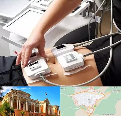 ترواسکالپ در خوی