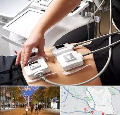 ترواسکالپ در ولیعصر ارومیه