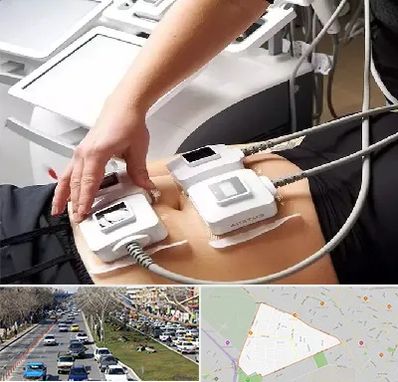 ترواسکالپ در احمدآباد مشهد 