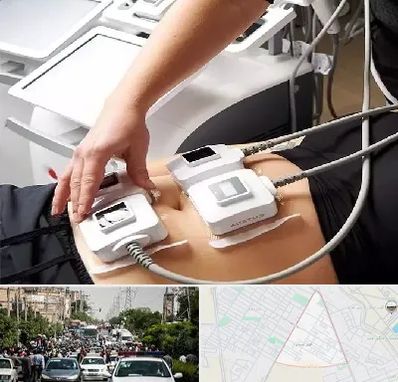 ترواسکالپ در سیدی مشهد