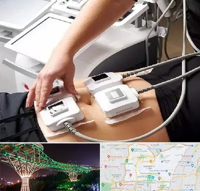 ترواسکالپ در منطقه 3 تهران 