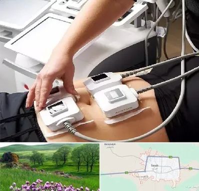 ترواسکالپ در سراب