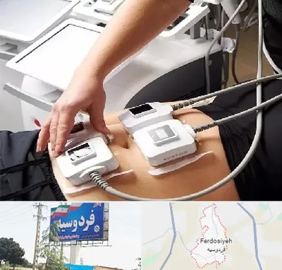 ترواسکالپ در فردوسیه شهریار