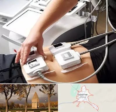 ترواسکالپ در تویسرکان