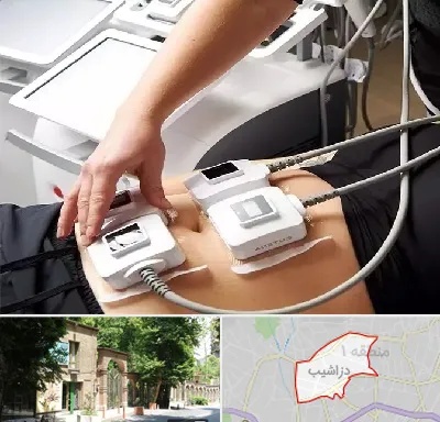 ترواسکالپ در دزاشیب