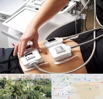 ترواسکالپ در منطقه 13 تهران 