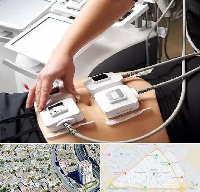 ترواسکالپ در قاسم آباد مشهد 