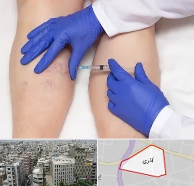 اسکلروتراپی در آذری