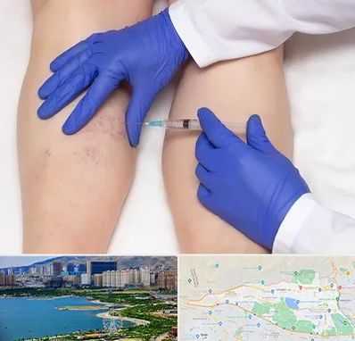 اسکلروتراپی در منطقه 22 تهران 