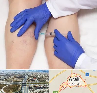 اسکلروتراپی در اراک