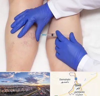 اسکلروتراپی در قم