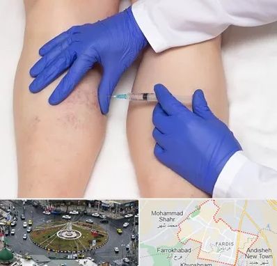 اسکلروتراپی در فردیس کرج 