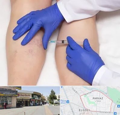 اسکلروتراپی در پرواز تبریز