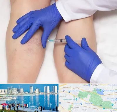 اسکلروتراپی در چیتگر 