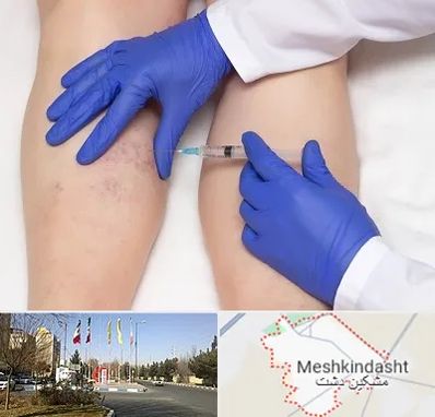 اسکلروتراپی در مشکین دشت