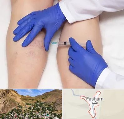 اسکلروتراپی در فشم