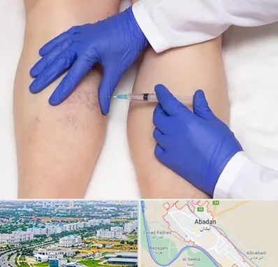 اسکلروتراپی در آبادان