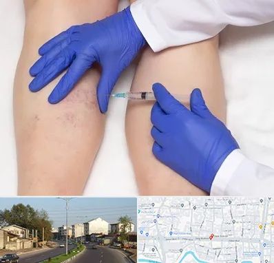 اسکلروتراپی در ضیابری رشت