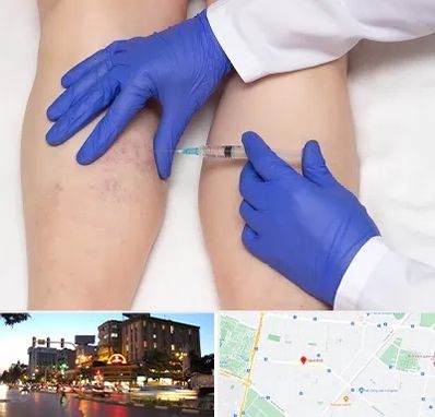 اسکلروتراپی در بلوار سجاد مشهد 