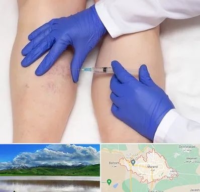 اسکلروتراپی در مرند