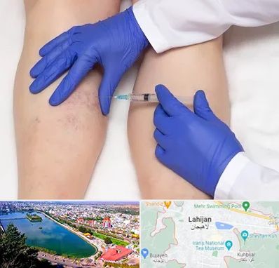 اسکلروتراپی در لاهیجان