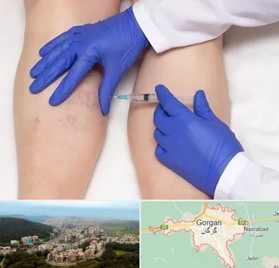 اسکلروتراپی در گرگان