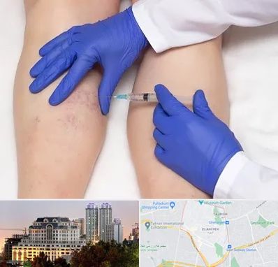 اسکلروتراپی در فرشته 