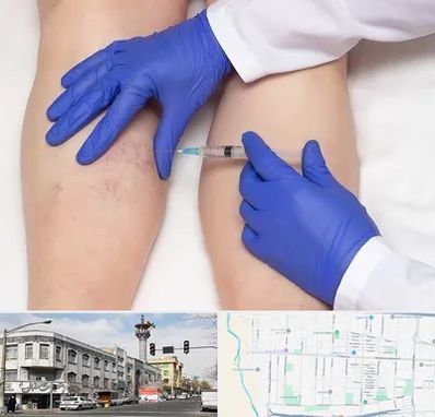 اسکلروتراپی در 17شهریور